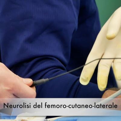 neurolisi del nervo femoro cutaneo laterale